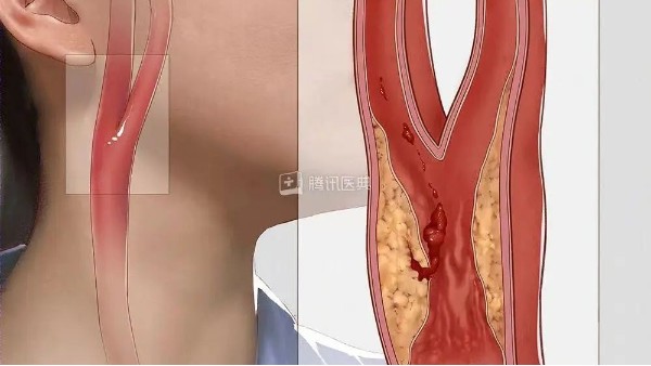 真實(shí)案例丨3個(gè)月左頸動(dòng)脈狹窄降低約27%，是怎么實(shí)現(xiàn)的？